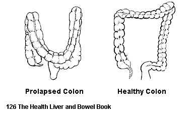 prolapsed colon and healthy colon