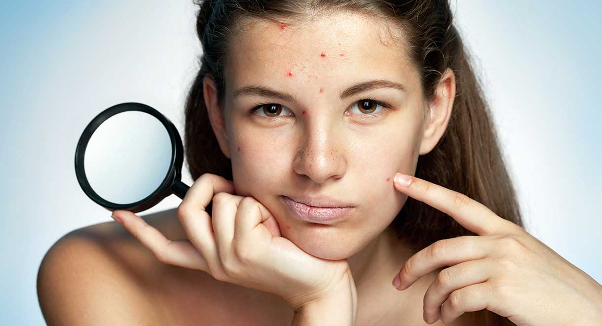 Acne - How To Treat Acne