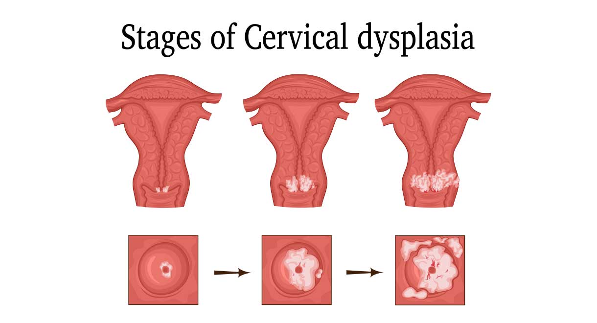 Cervical Dysplasia | Liver Doctor