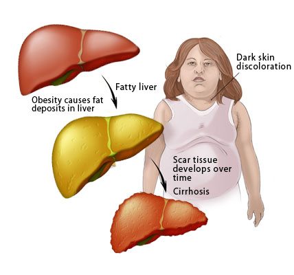 Liver-Doctor-Fatty-Liver