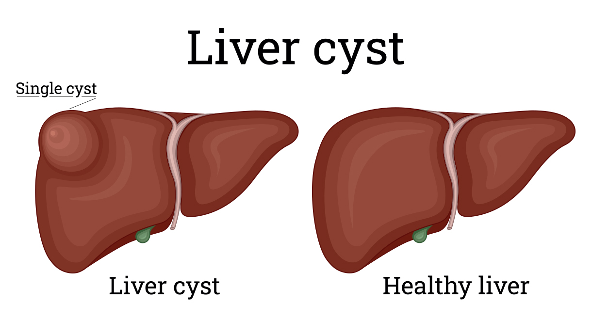 Liver Cysts: What they are and what to do about them