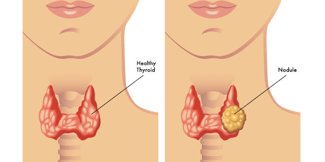 What to do for thyroid nodules