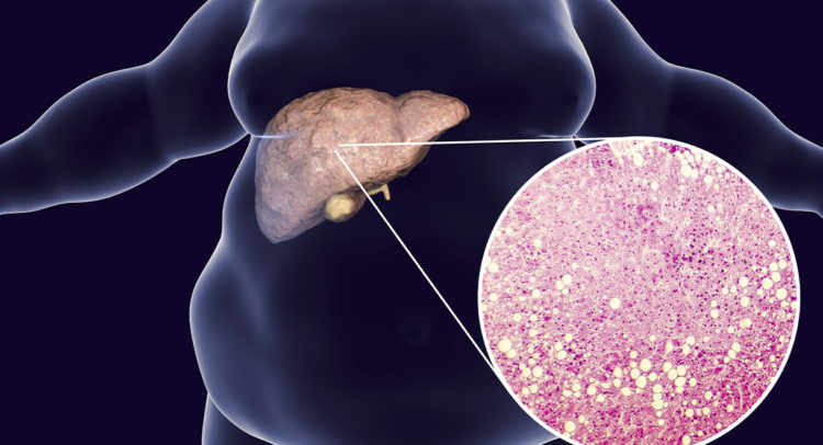 Healing my fatty liver