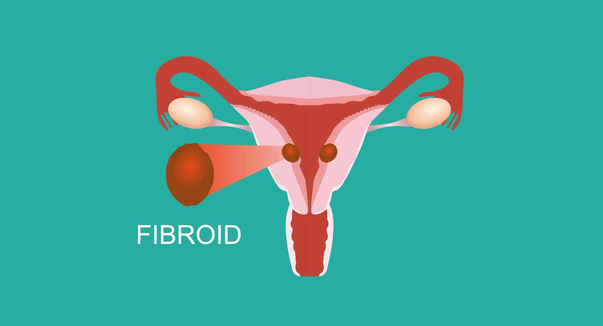Fibroids