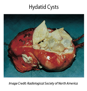 Liver-Doctor-Hydatid-Cysts-Of-Liver