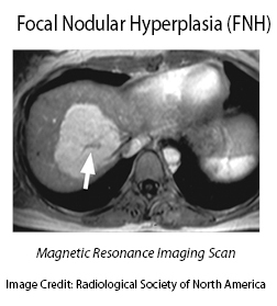 Liver-Doctor-Focal-Nodular-Hyperplasia-MRI-Scan