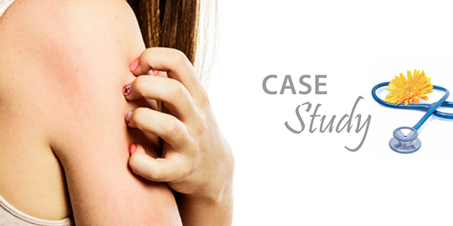 Case study: Overcoming chronic urticaria (hives)