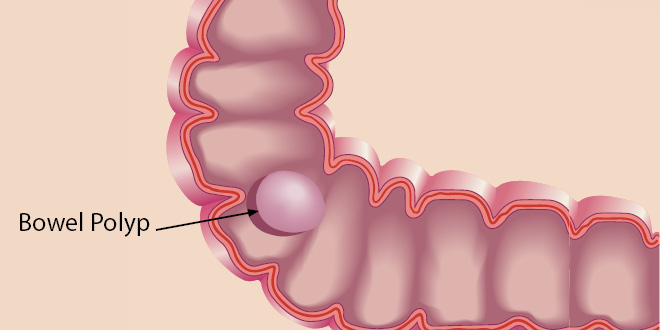Should You Be Concerned About Bowel Polyps?