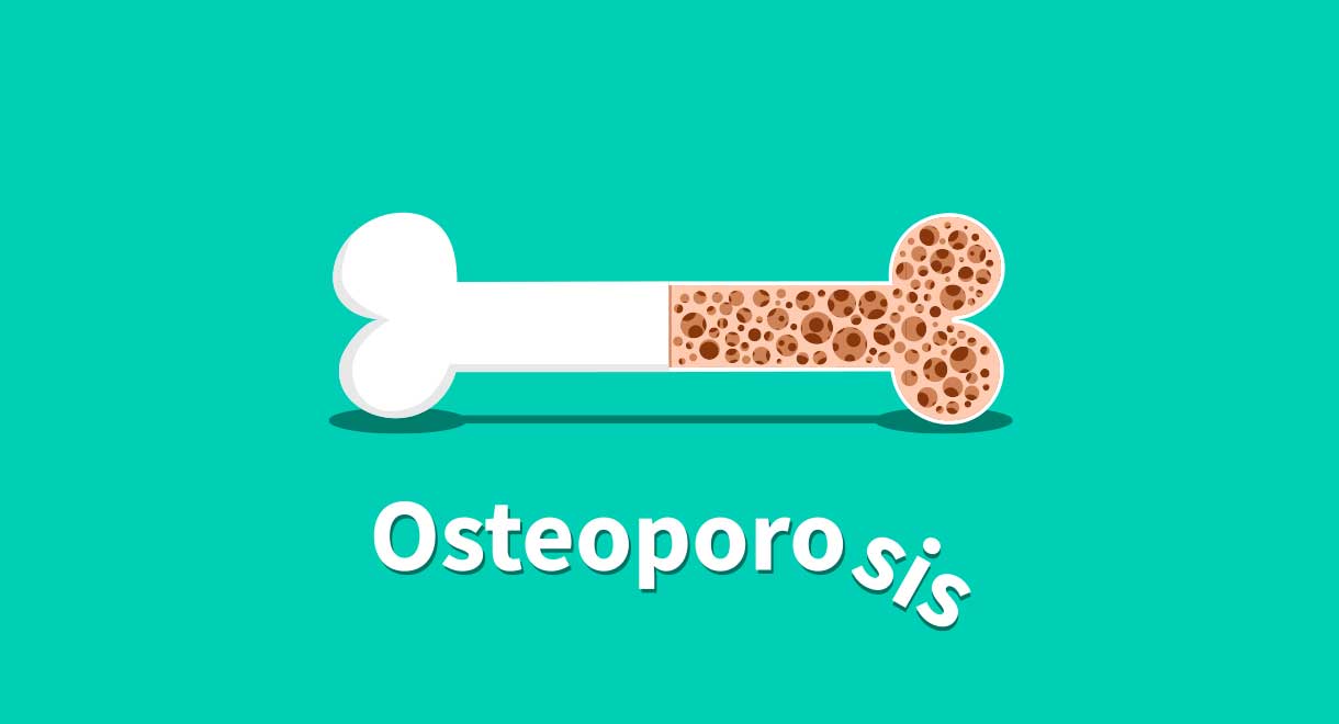 Osteoporosis And The Best Solutions