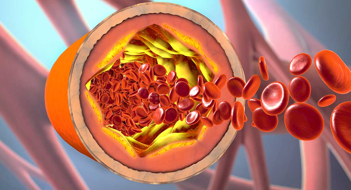 Celiac Disease Doubles The Risk Of Coronary Artery Disease