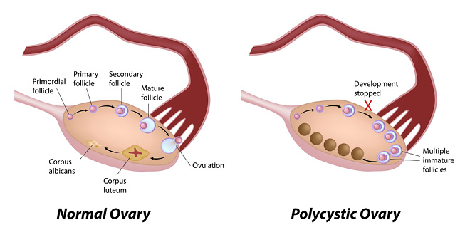 Polycystic Ovarian Syndrome Undetected