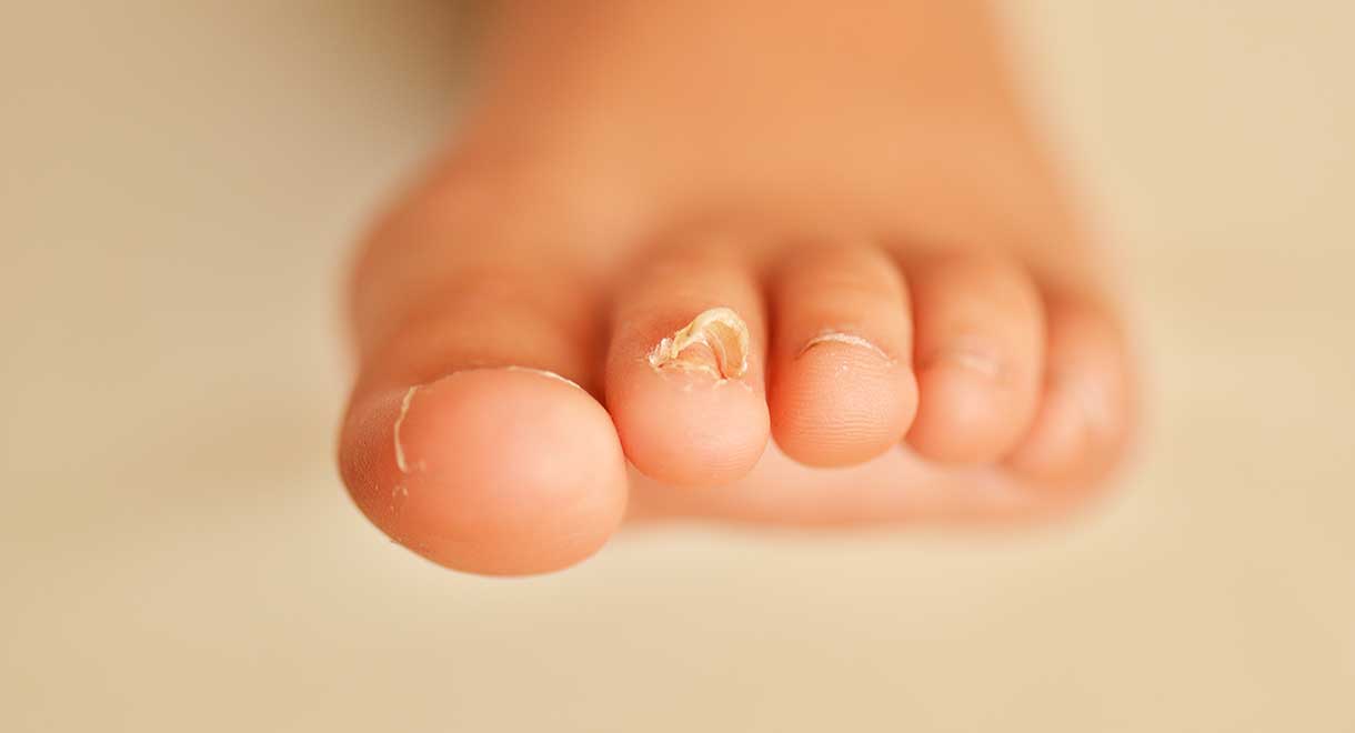 Fungal Toe Nails – A Safe Cure