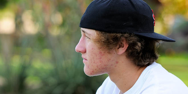 A high carb diet is bad for your skin