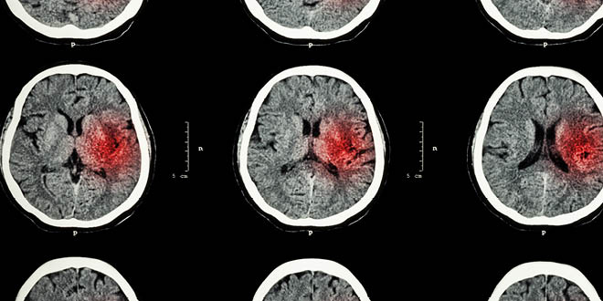 Most strokes are preventable