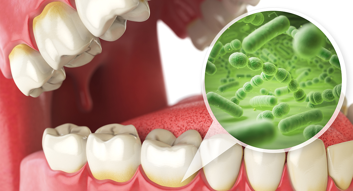 Gum Disease May Signal Stroke Risk