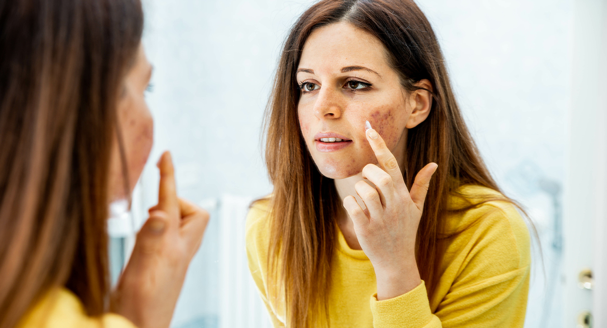 7 Surprising Causes Of Acne