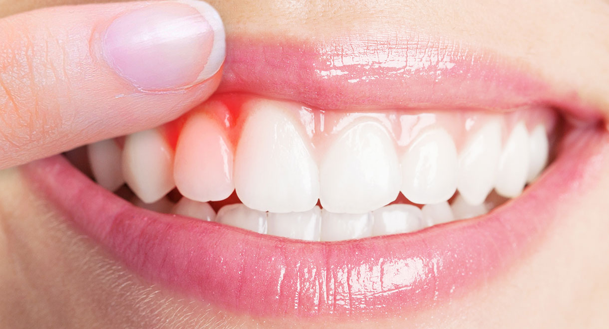 Gum Disease Linked To Cancer Risk