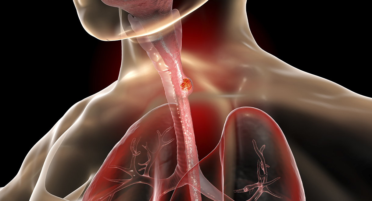Dramatic Rise In Esophageal Cancer