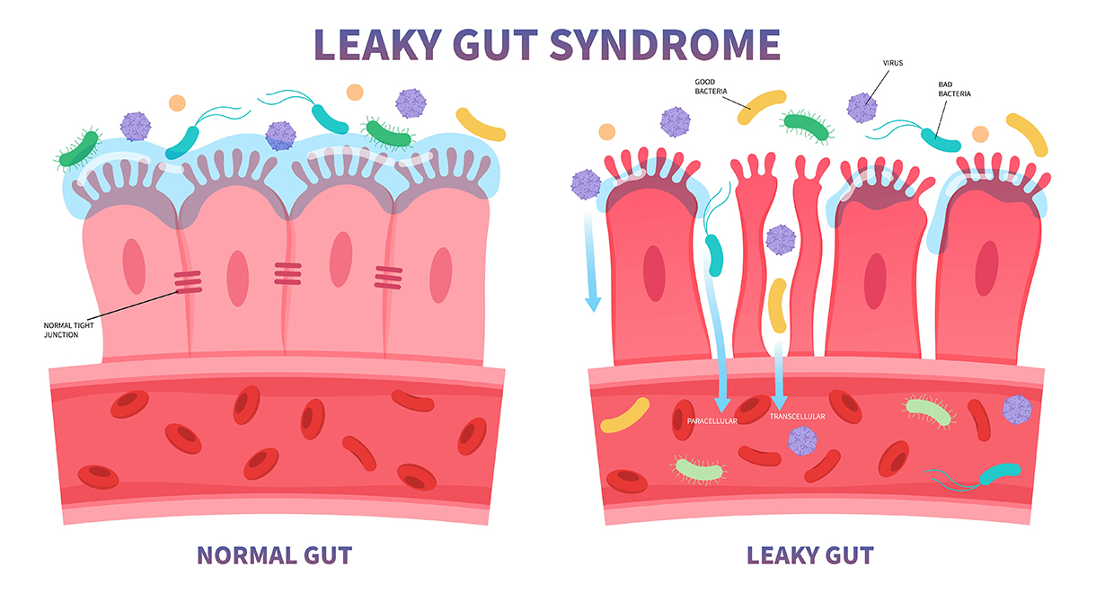 Leaky Gut Can Make Fatty Liver Worse
