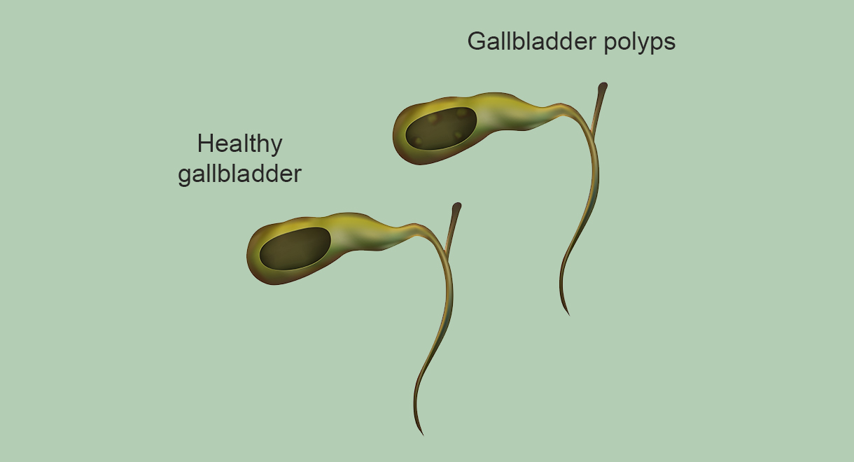 Should You Worry About Gallbladder Polyps?