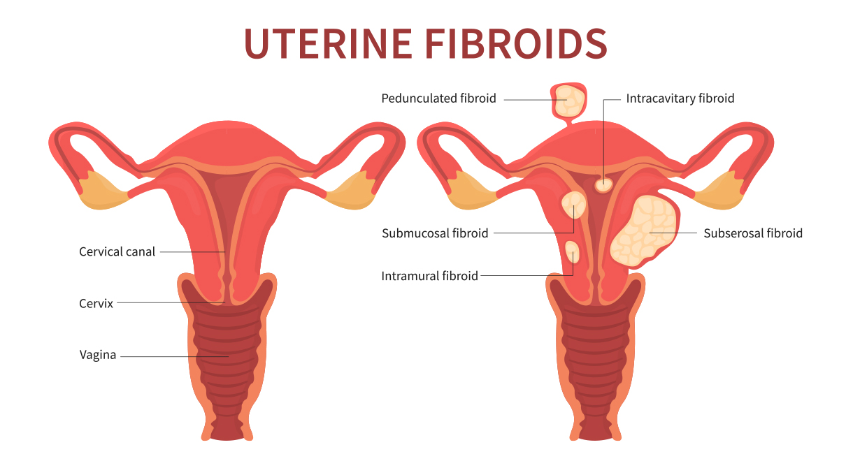 Natural Remedies For Uterine Fibroids