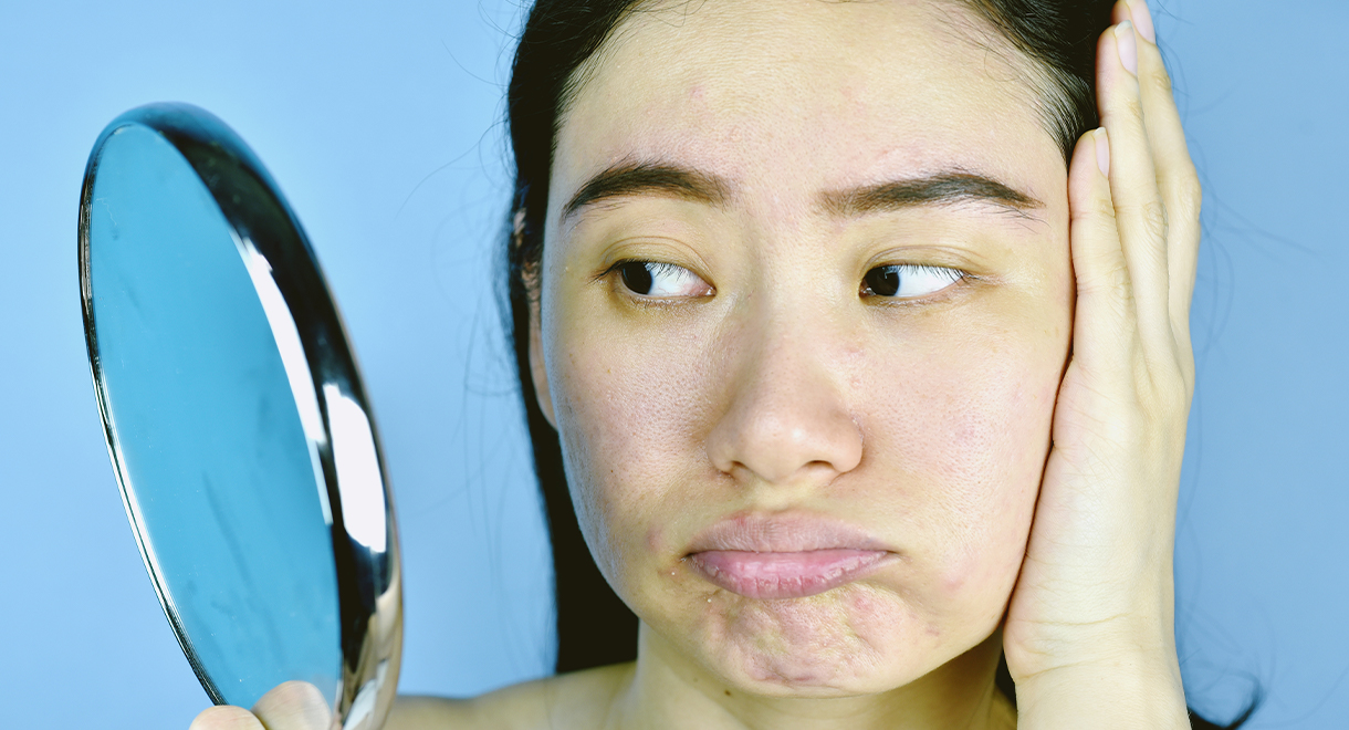 Do You Know What Really Causes Acne?
