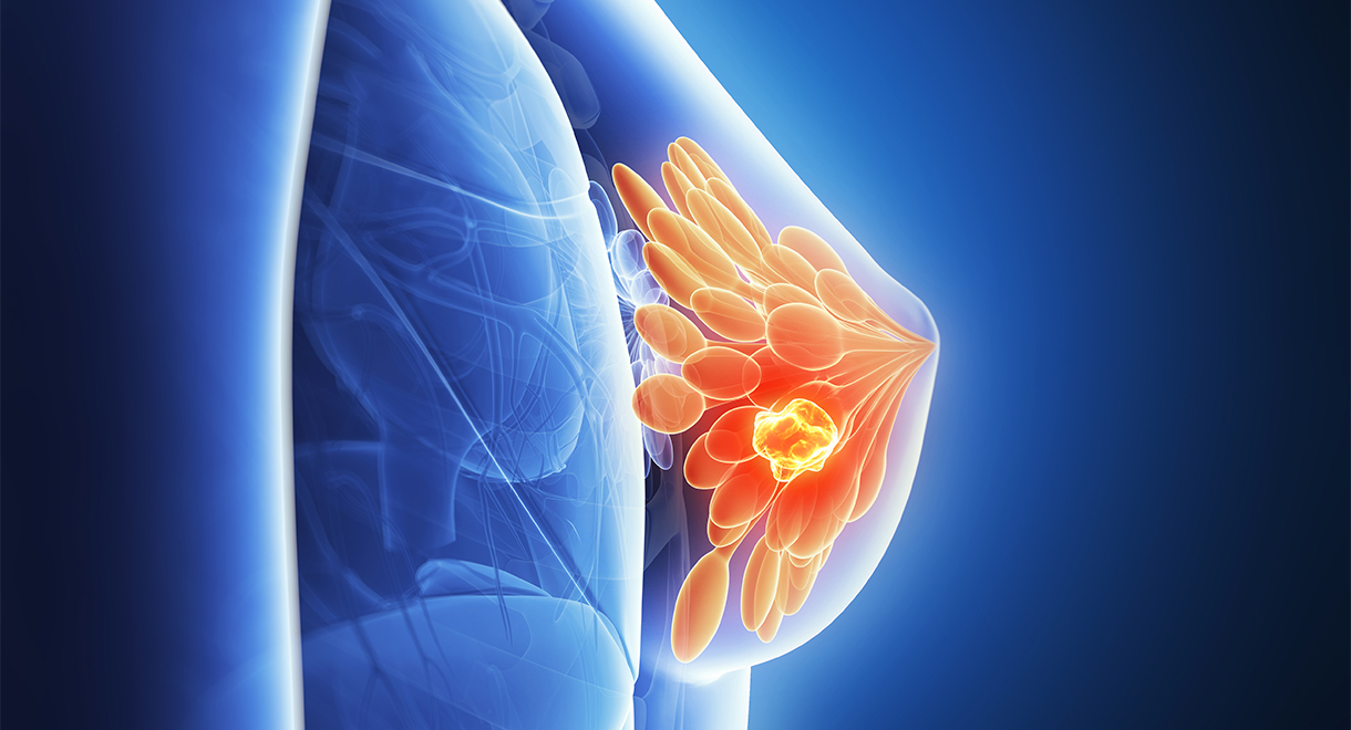 Insulin May Fuel Breast Cancer Growth