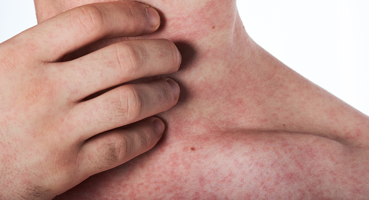 Your Skin Problem May Be Due To An Unhealthy Liver