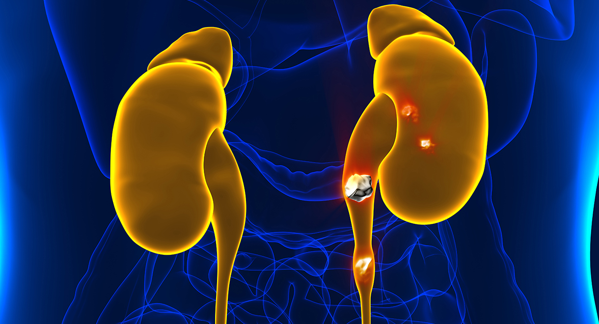 case study of kidney stone