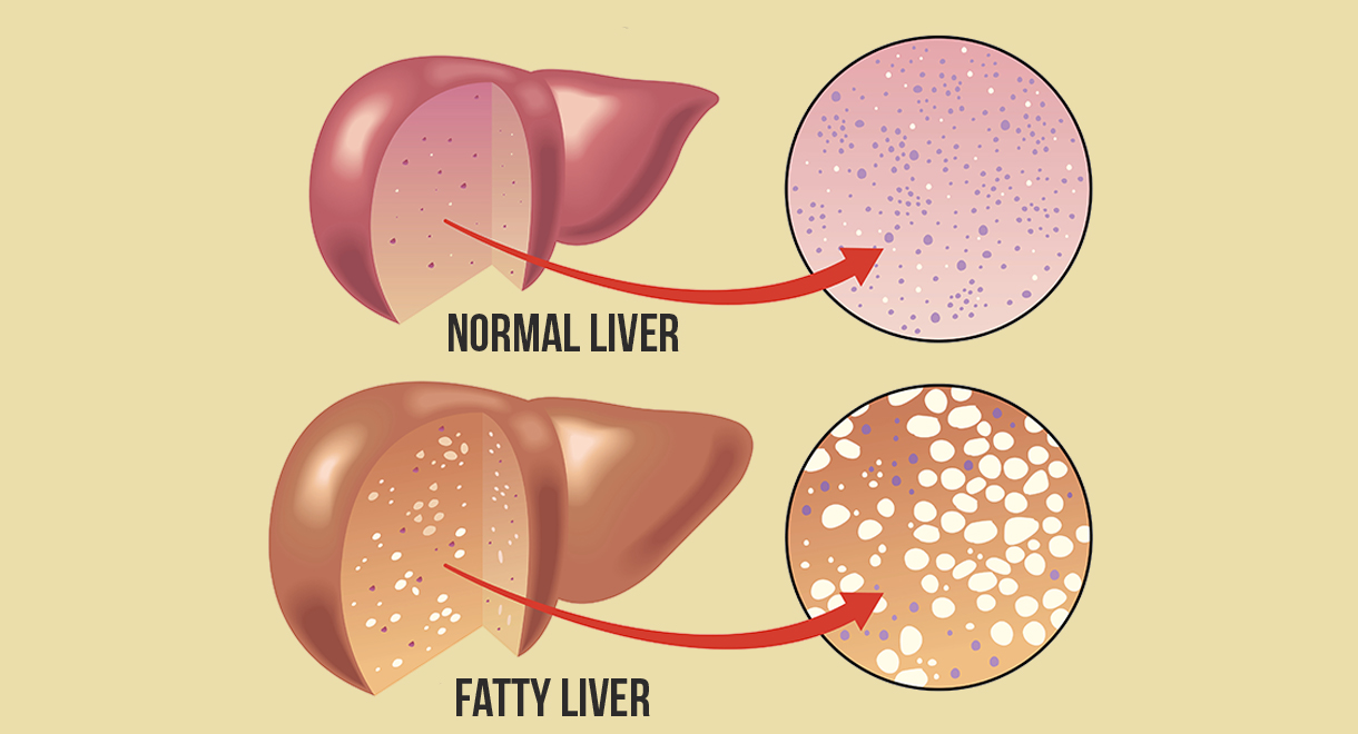 Fatty Liver Can Damage Other Organs