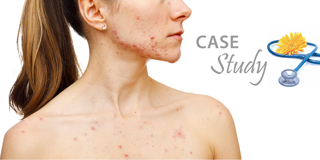 Case Study: Overcoming Acne
