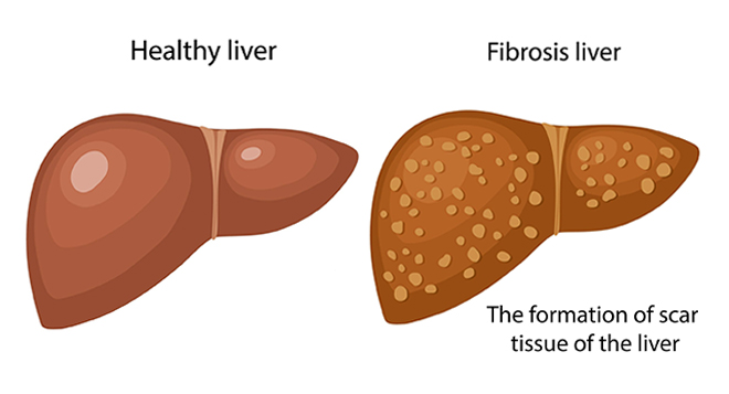 Healthy liver fibrosis liver