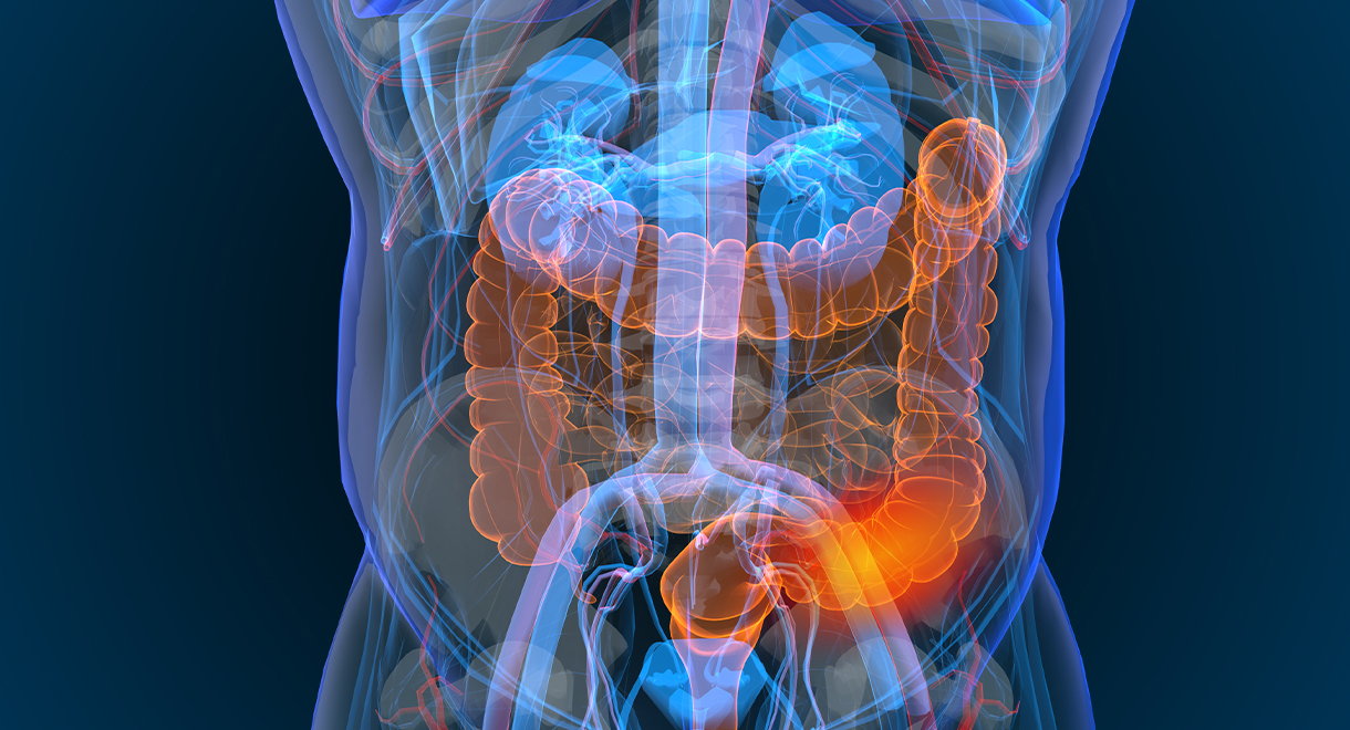 Do You Know These 5 Colon Cancer Warning Signs?