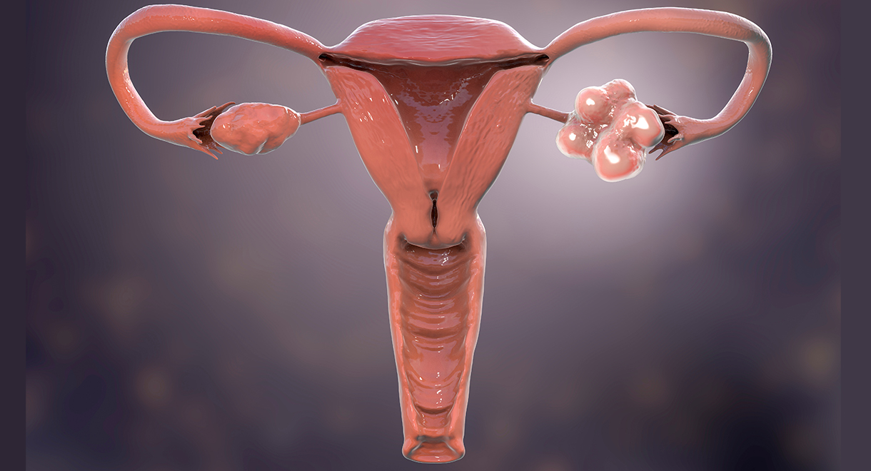 Case Study: Polycystic Ovaries And Hair Loss