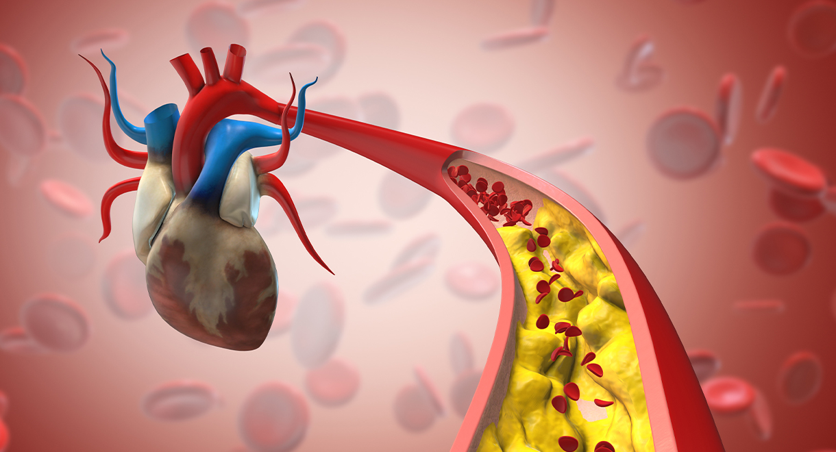 Insulin Resistance Will Clog Your Arteries