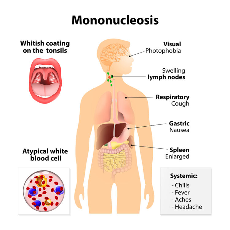 Mononucleosis