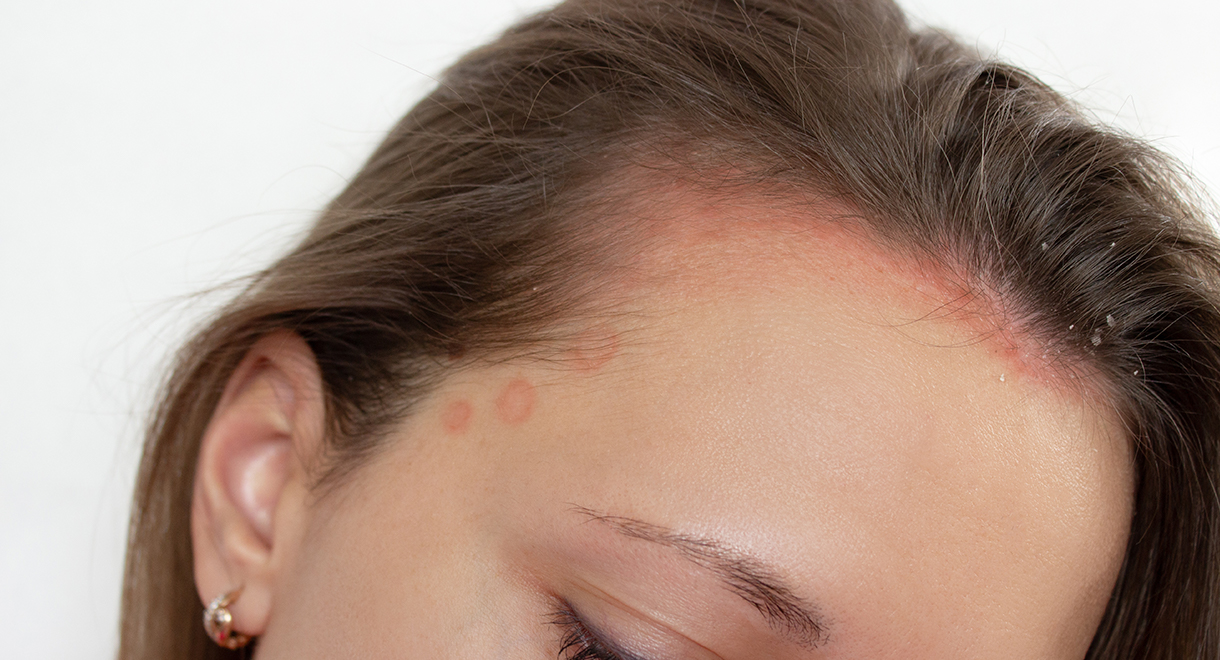 Case Study: Psoriasis And Migraines