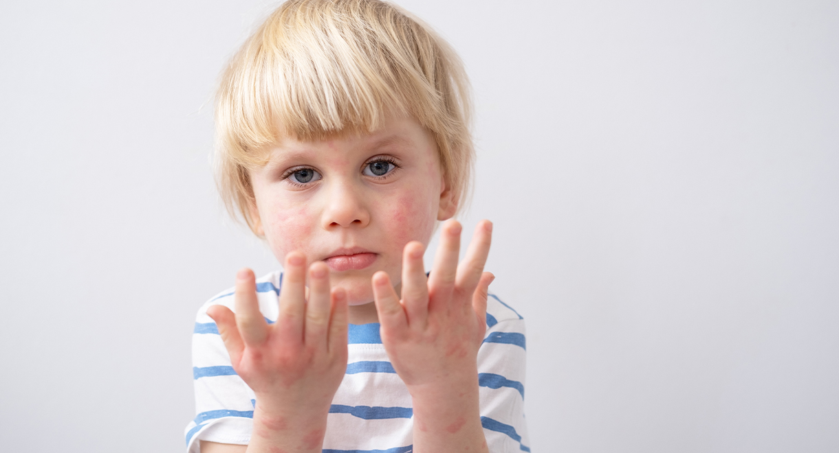 How To Help A Child With Eczema