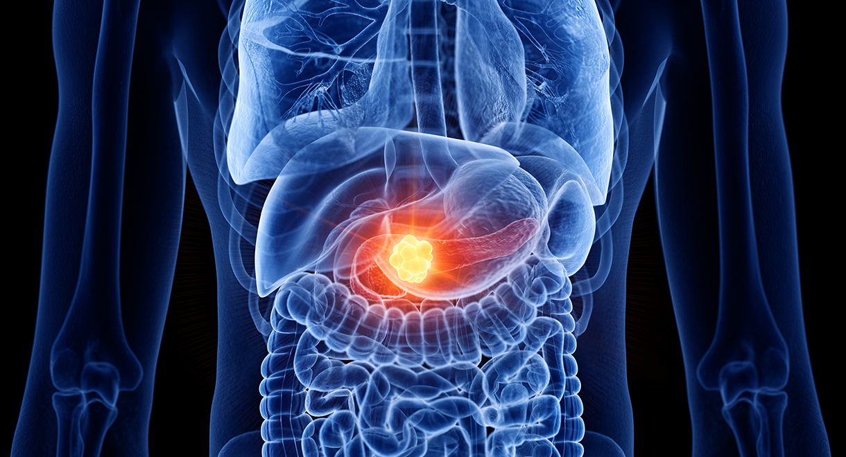 Fatty Liver Almost Doubles Pancreatic Cancer Risk